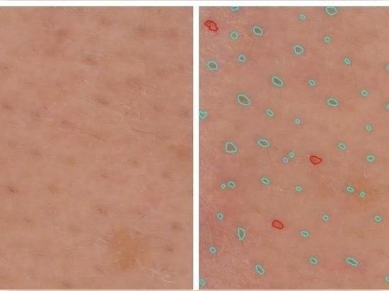Blackheads analysis
