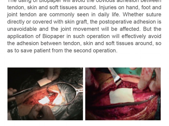 Biopaper ® is a new type patented bio-degradable hemostatic material.