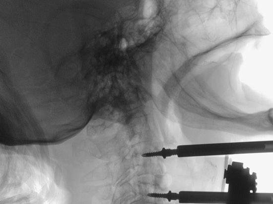 Thanks to AIRE – Automatic Intelligent Radiographic Engine, every fluoroscopic image is optimized automatically. Even in complex surgeries or scenary, AIRE ensures clear visualization of all anatom...