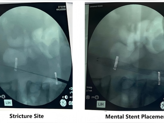 The First Affiliated Hospital of Guangzhou Medical University has successfully completed the first clinical application of a domestic covered ureteral stent system for the treatment of recurrent ur...