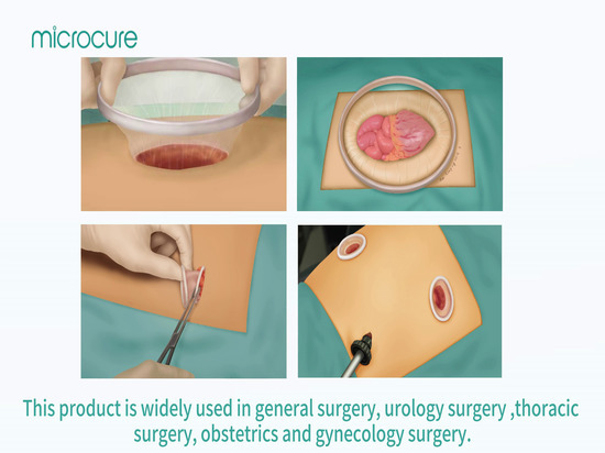 The Disposable Incision Protection Sleeve - Jia Ling Jiang Lu, Hu Qiu ...