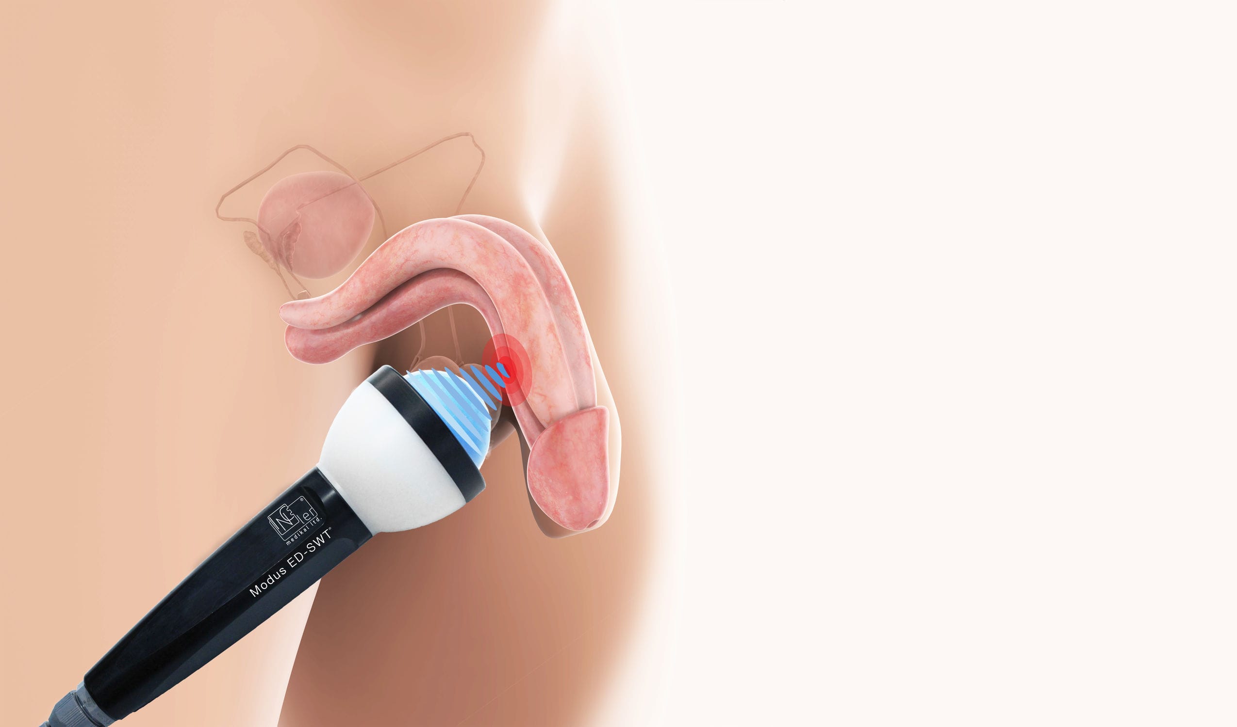 勃起不全用体外衝撃波疼痛治療装置 - MODUS FOCUSED - Inceler Medikal