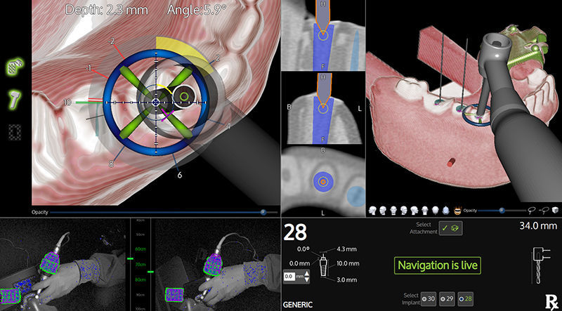 歯科手術手術ナビゲーションシステム - X-Guide® - X-Nav Technologies