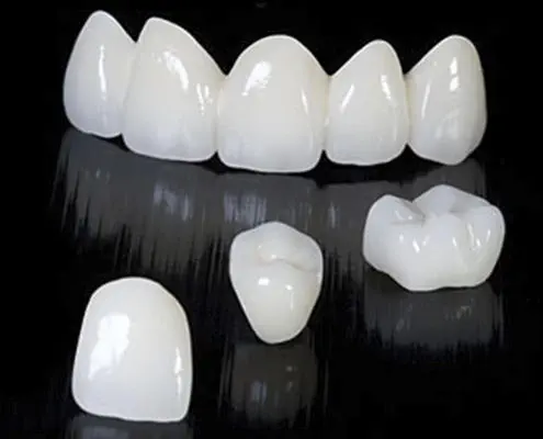 ジルコニア製歯科用ブリッジ - CRYSTAL - Derby Dental - 前歯