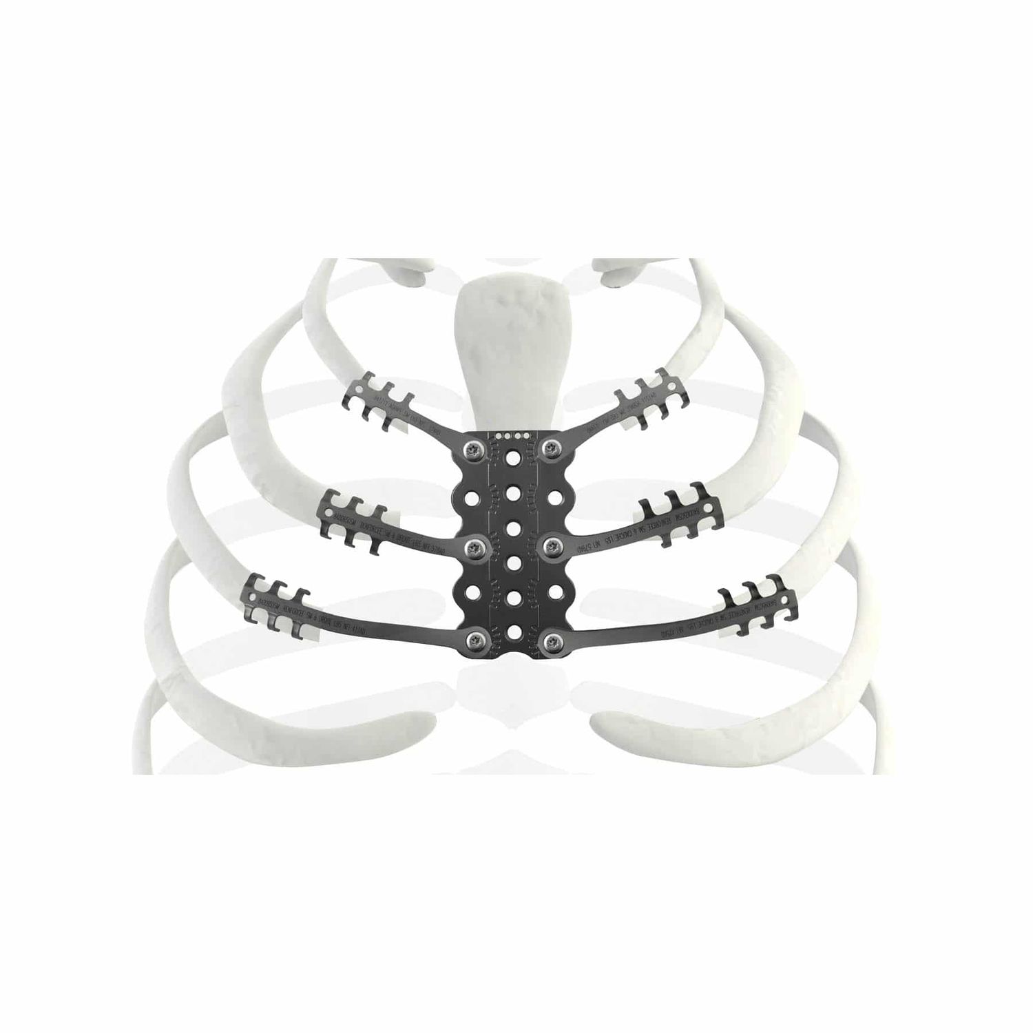 骨肉腫の切除後の再建用肋骨用プロテーゼ - TRIONYX® - NEURO FRANCE