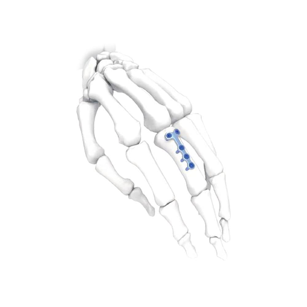 手用圧迫プレート - T - NORMMED Medical Devices - 足用 / ロッキング / 金属製