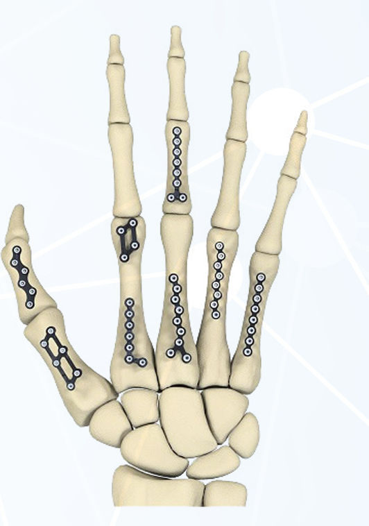 指骨用圧迫プレート - FRC series - Aleda Medical - 中手指節関節用 / ロッキング / 金属製