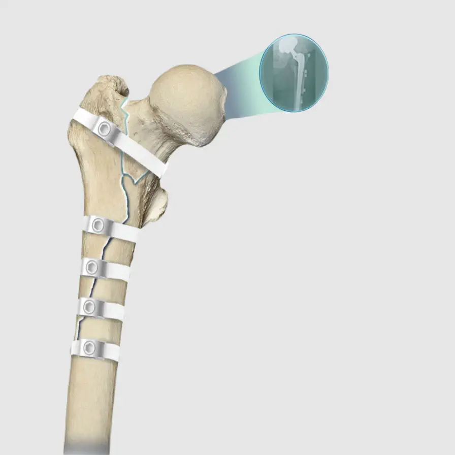 人工股関節置換手術用骨締結用ワイヤー - Ortholox® UHMWPE - Ortolog