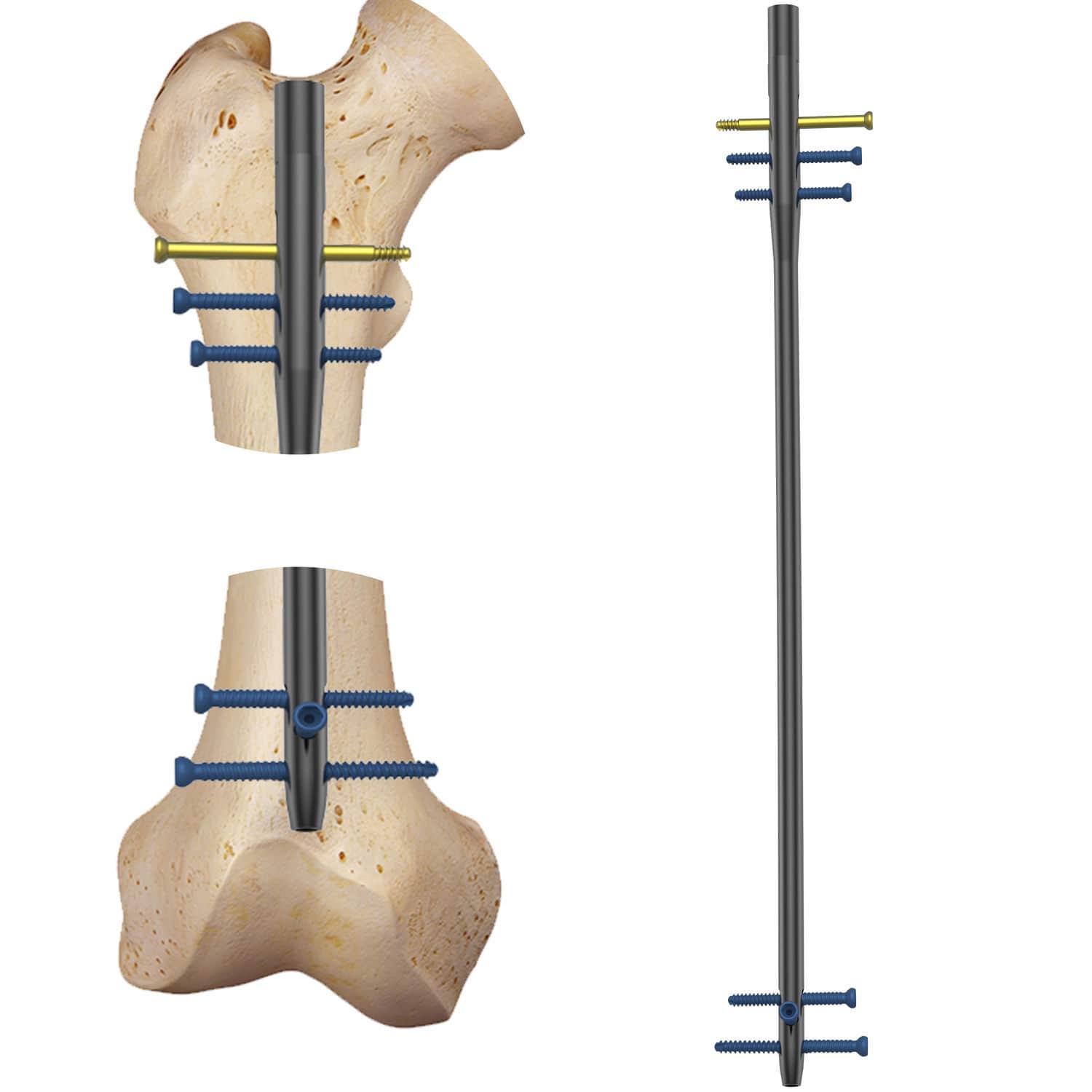 医療用　チタン　大腿骨、スネ　２本 大腿骨用髄内釘 - Navy-S A/R - Dunitech - チタン製