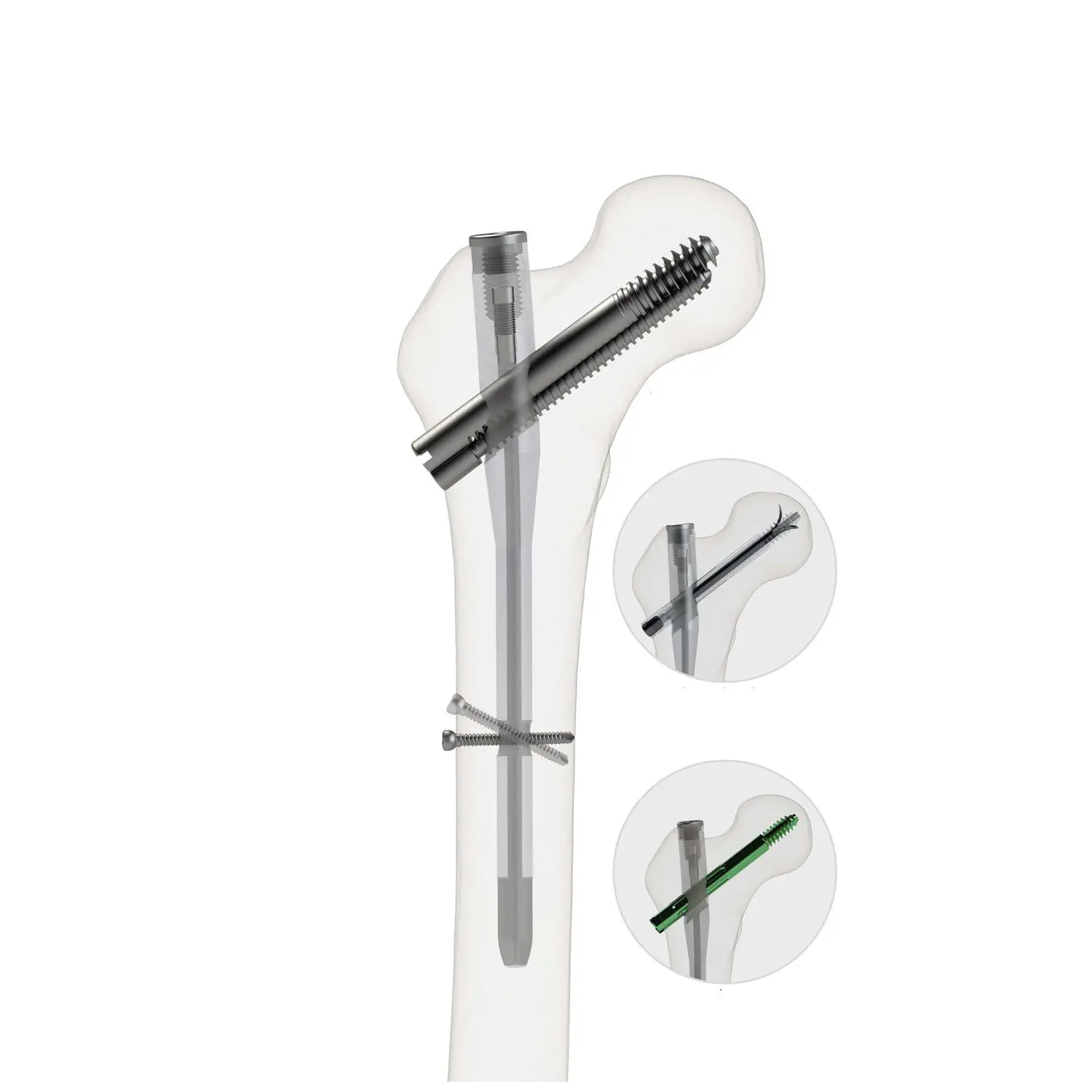 大腿骨用髄内釘 - 4552-1017 - Zimed Medical - 近位固定 / 右 / 左側