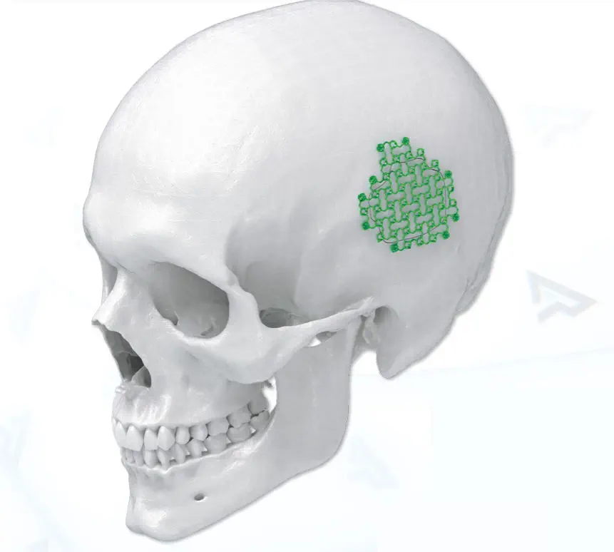 非吸収性頭蓋固定装置 - 4003008 - AGOMED Medizin-Technik