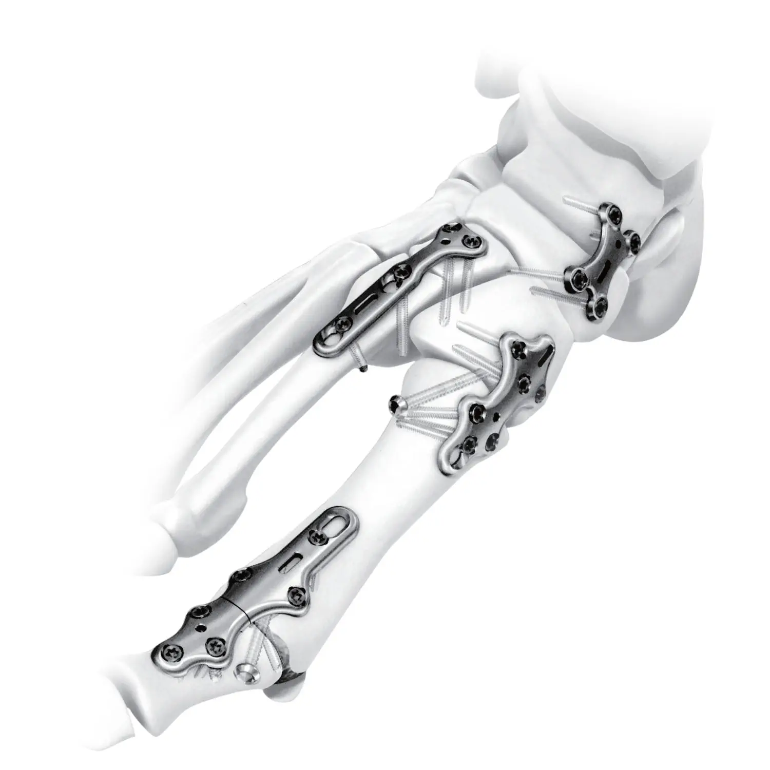 骨連結用の医療器具だと思います 足根関節用圧迫プレート - Kangli Medical - 中足指節関節用 / 根中足