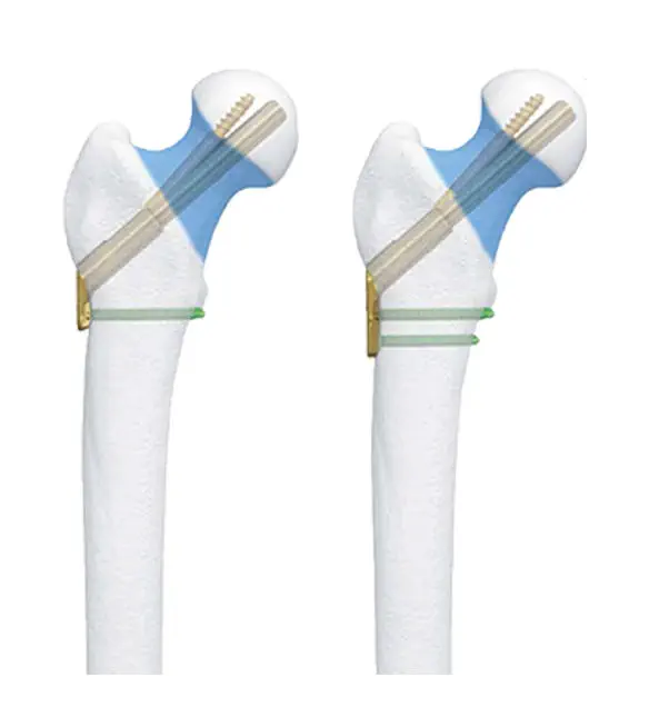 大腿骨骨頭用圧迫プレート - Chongqing FWS Medical Devices