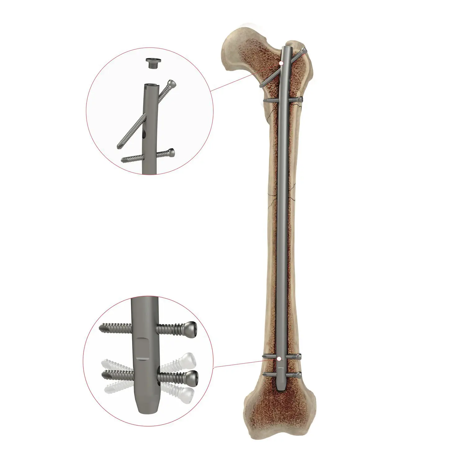 大腿骨用髄内釘 - AS.AFN.400 - Ases Orthopedics - 近位固定 / 遠位
