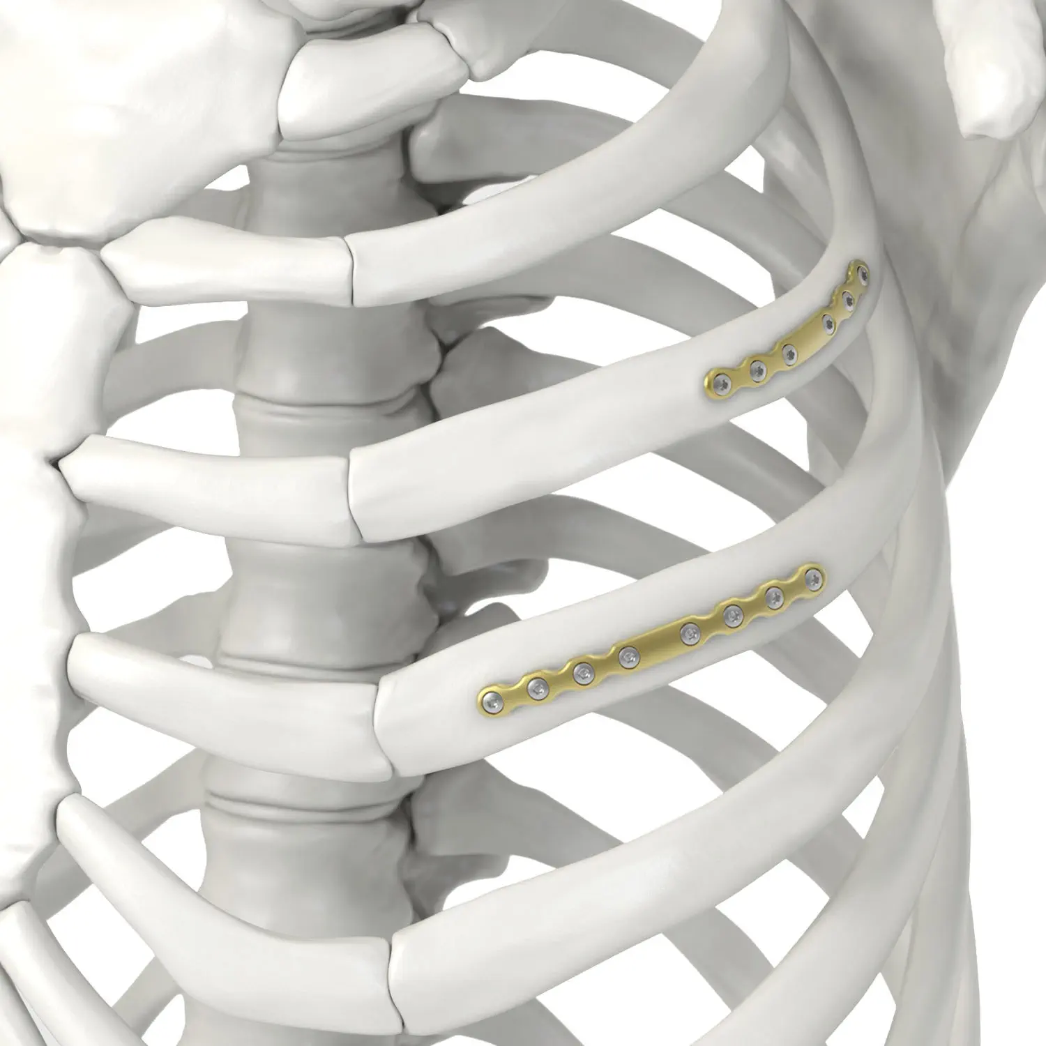 肋骨用圧迫プレート - Jeil Medical Corporation - ロッキング / チタン製