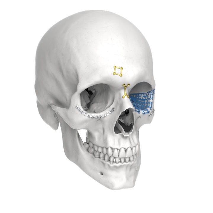 上顎骨用圧迫プレート - LeForte - Jeil Medical Corporation - ノン