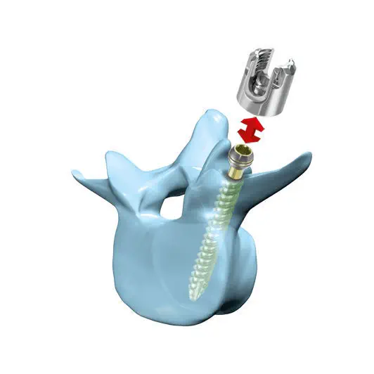 腰椎椎弓根スクリュー - “mediRod®”-Tri - Medicon eG - 複軸 / カニューレ