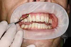 ほおレトラクタ - OptraGate - Ivoclar Vivadent - 唇 / 歯科用