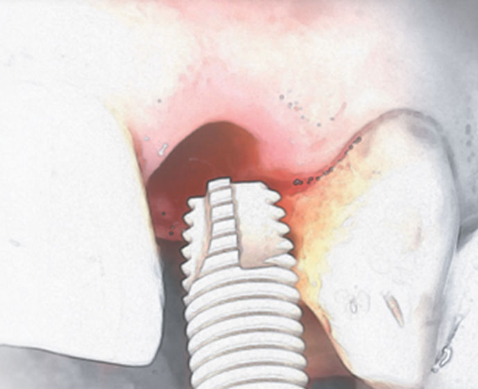 円筒形歯科インプラント - Osseotite® - Zimmer Dental - チタン