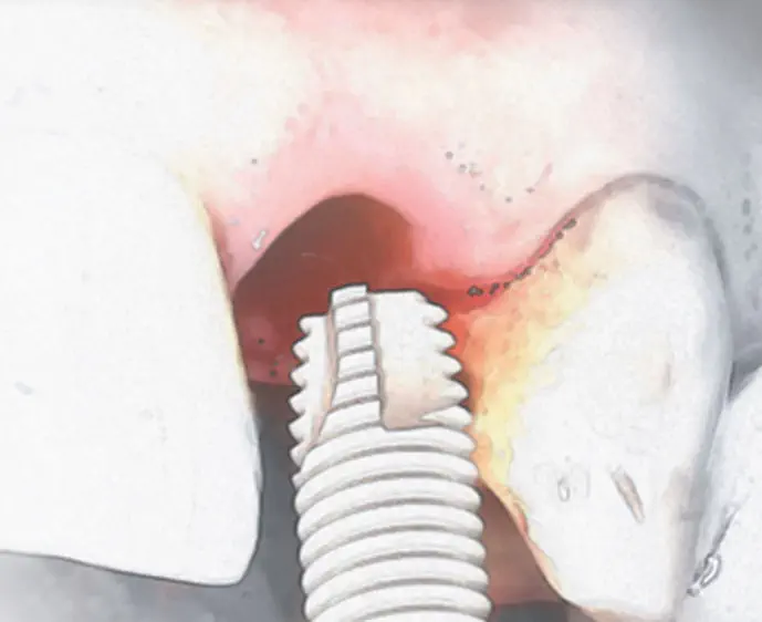 円筒形歯科インプラント - Osseotite® - Zimmer Dental - チタン製