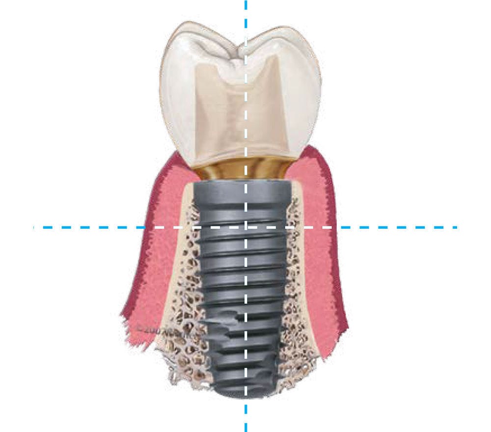 歯科インプラント器具一式 - SGTIKIT - Zimmer Dental