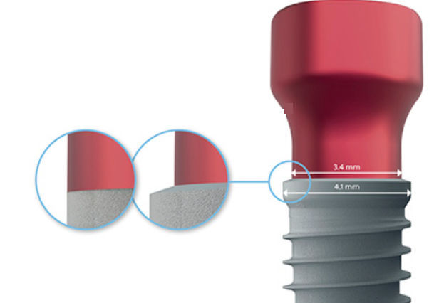 テーパー歯科インプラント - T3® PRO - Zimmer Dental - チタン製