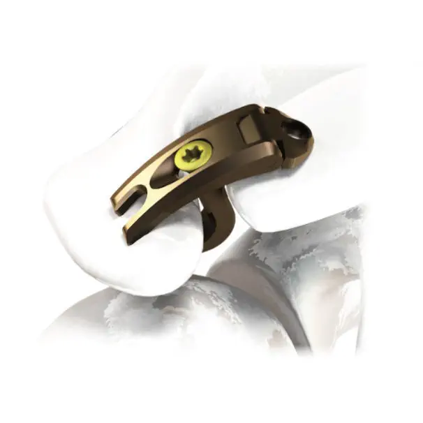 肩峰鎖骨関節用関節固定プレート - 3.7242.11 series - ChM