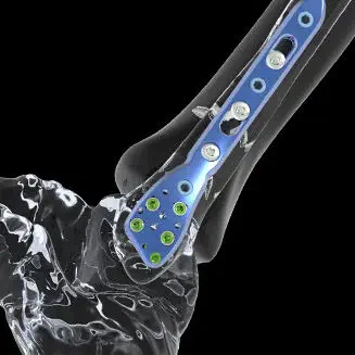 脛骨用圧迫プレート - FTS1 - Newclip Technics - 腓骨用 / 足首用