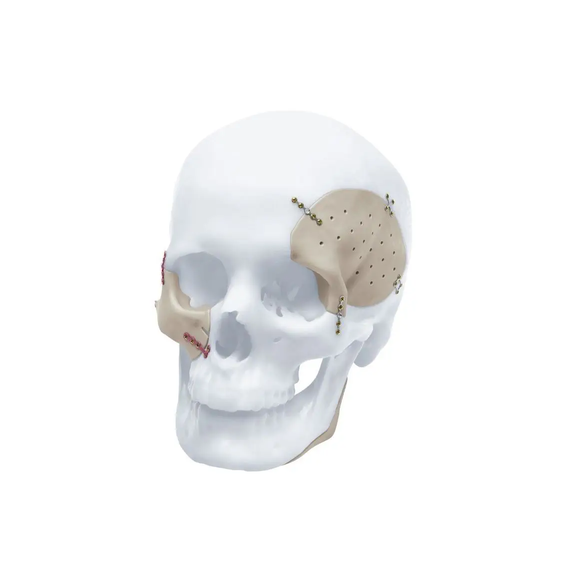高質で安価 - オーダーメイド頭蓋インプラント TRUMATCH™ Synthes Depuy - 健康・医学