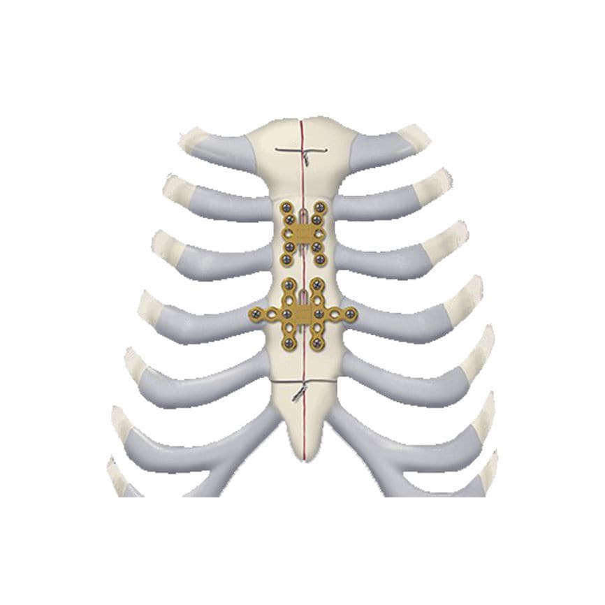 胸骨用関節固定プレート - 460 series - Depuy Synthes - 肋骨用