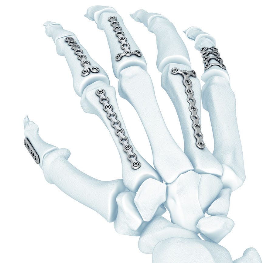 中手指節関節用圧迫プレート - LCP® - Depuy Synthes
