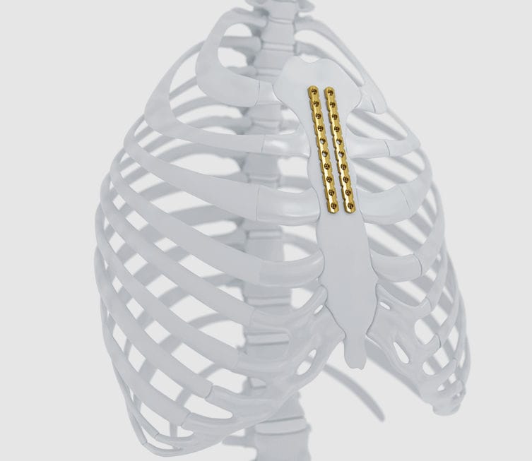 肋骨用圧迫プレート - MatrixRIB™ - Depuy Synthes - 胸骨用 / 胸椎