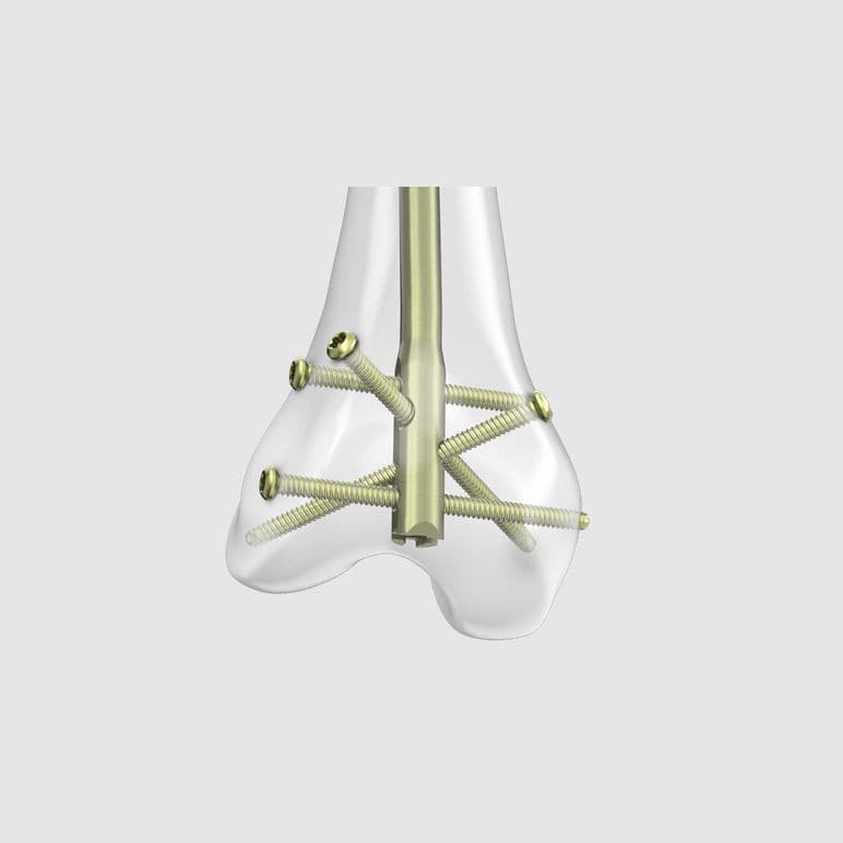 大腿骨用髄内釘 - RFN-ADVANCED™ - Depuy Synthes - 遠位固定 / 金属製