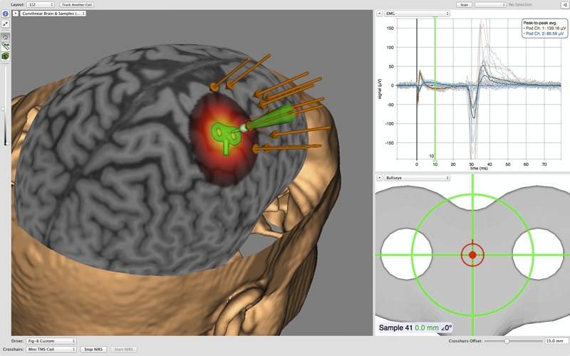 TMSニューロ ナビゲーションシステム - Brainsight® - Brainbox