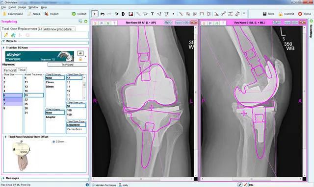 手術前プランニング用ソフト - Knee Arthroplasty - OrthoView - 膝手術用