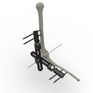 肘用外部固定システム