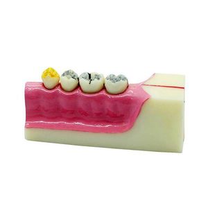 歯の解剖模型
