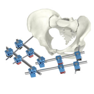 骨盤の外部固定システム