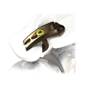 肩峰鎖骨関節用関節固定プレート - 3.7242.11 series - ChM