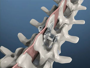 腰椎棘間椎骨インプラント