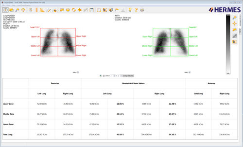分析ソフト - Lung Lobe Quantification™ - Hermes Medical Solutions, Inc - 診断用 / 計画用 / 評価