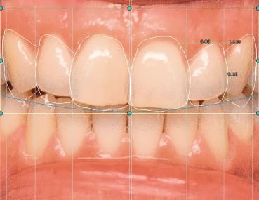 CADソフトウェアモジュール - 4218U - Champions Implants GmbH - FAO / 笑顔デジタル設計用 / 歯科用