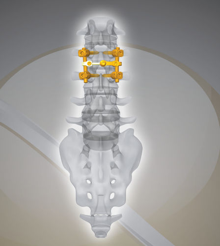 腰椎骨接合システム - NEX D2 - Next Orthosurgical - 後方進入