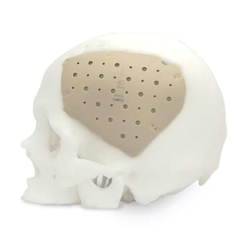 オーダーメイド頭蓋インプラント - CranioPEEK3D ™ - Kontour Medical Technology