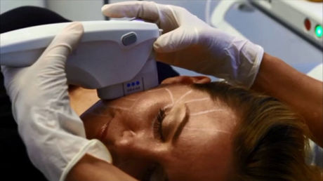 超高周波ピーリング機 - Ultherapy® - Merz Pharma - 高密度焦点式超音波ボディ・コントゥアリング装置 / 台車上