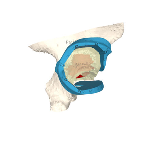 人工股関節用骨切りガイド - 3D Side