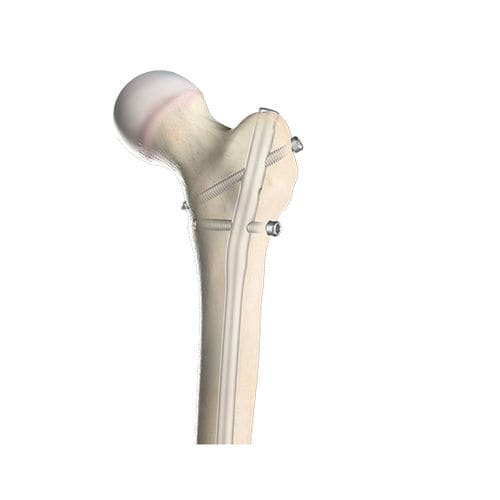 大腿骨用髄内釘 - 00-1501-0720 - OrthoPediatrics - 近位固定 / 遠位固定 / 子供用