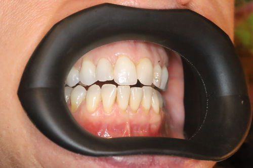 唇レトラクタ - VisionButler™ - Gate Dental Services Ltd - ほお / 歯科用 / オートクレーブ