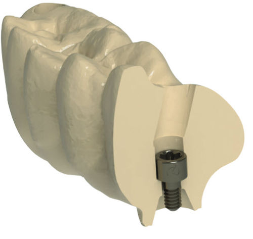 歯の修復用歯科材料 - G-DAS - Dynamic Abutment Solutions - CAD/CAM / 製粉 / 高透明