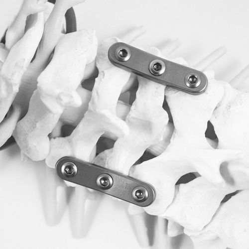 頚椎用関節固定プレート - STABILAR® PCP - NEURO FRANCE Implants - ノンロッキング / チタン製